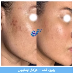 roze abi fecial clinic (1) سالن فشیال صورت لیا بهترین سالن فشیال صورت در غرب تهران