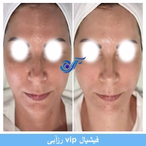 roze abi fecial clinic (5) سالن فشیال صورت لیا بهترین سالن فشیال صورت در غرب تهران
