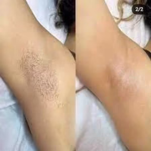 Hera laser center3 مرکز لیزر هرا بهترین مرکز لیزر در اصفهان