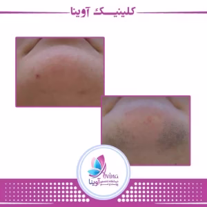 markz lizar avina1 مرکز لیزر آوینا بهترین مرکز لیزر در کرج
