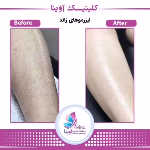 markz lizar avina2 مرکز لیزر آوینا بهترین مرکز لیزر در کرج