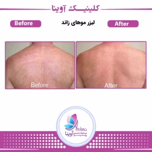markz lizar avina3 مرکز لیزر آوینا بهترین مرکز لیزر در کرج