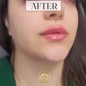 Bonita lip gel injection center (2) مرکز تزریق ژل لب بنیتا بهترین مرکز تزریق ژل لب در اصفهان