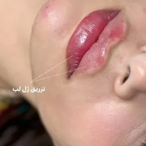 Bonita lip gel injection center (3) مرکز تزریق ژل لب بنیتا بهترین مرکز تزریق ژل لب در اصفهان