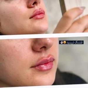 Bonita lip gel injection center مرکز تزریق ژل لب بنیتا بهترین مرکز تزریق ژل لب در اصفهان