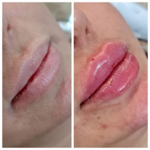 Dr. Mahsa Mousavi Manesh Lip Gel Injection Center (1) مرکز تزریق فیلر لب دکتر مهسا موسوی منش بهترین مرکز فیلر در اصفهان