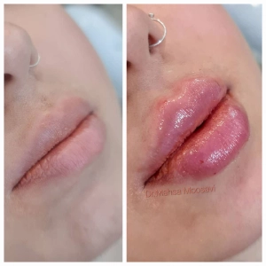 Dr. Mahsa Mousavi Manesh Lip Gel Injection Center (3) سالن زیبایی مهسا موسوی منش بهترین سالن زیبایی در اصفهان