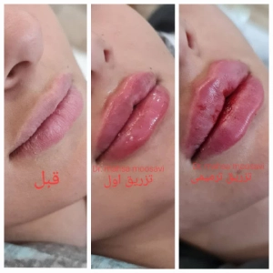 Dr. Mahsa Mousavi Manesh Lip Gel Injection Center (4) مرکز تزریق ژل لب دکتر مهسا موسوی منش