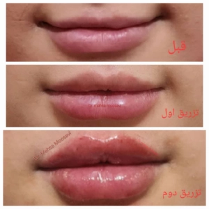 Dr. Mahsa Mousavi Manesh Lip Gel Injection Center مرکز تزریق فیلر لب دکتر مهسا موسوی منش بهترین مرکز فیلر در اصفهان