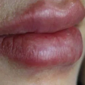 Dr. Maryam Maleki Lip Filler Injection Center (1) مرکز تزریق فیلر لب دکتر مریم ملکی بهترین مرکز تزریق فیلر لب در اصفهان