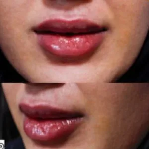 Dr. Maryam Maleki Lip Filler Injection Center (2) مرکز تزریق فیلر لب دکتر مریم ملکی بهترین مرکز تزریق فیلر لب در اصفهان