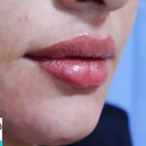 Dr. Maryam Maleki Lip Filler Injection Center (4)