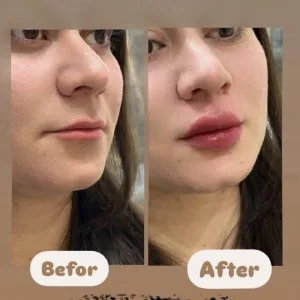 Dr. Ramin Modaresi Lip Filler Injection Center (1) مرکز تزریق فیلر لب دکتر رامین مدرسی بهترین مرکز تزریق فیلر لب در اصفهان