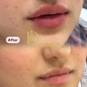 Dr. Ramin Modaresi Lip Filler Injection Center (4) مرکز تزریق فیلر لب دکتر رامین مدرسی بهترین مرکز تزریق فیلر لب در اصفهان
