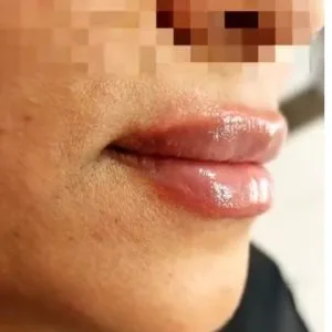 Dr. Saadati Lip Filler Injection Center (1) مرکز تزریق فیلر لب دکتر سعادتی بهترین مرکز تزریق فیلر لب در اصفهان