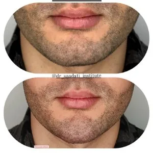 Dr. Saadati Lip Filler Injection Center مرکز تزریق فیلر لب دکتر سعادتی بهترین مرکز تزریق فیلر لب در اصفهان