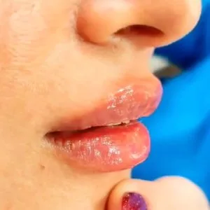 Dr. Saadati Lip Filler Injection Center (4) مرکز تزریق فیلر لب دکتر سعادتی بهترین مرکز تزریق فیلر لب در اصفهان