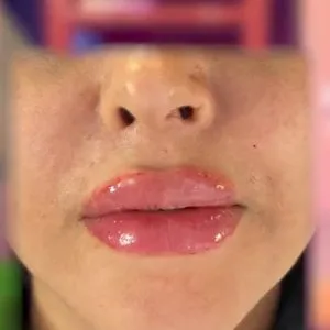 Dr. Yalda Attarzadeh Lip Filler Injection Center (3) مرکز تزریق فیلر لب دکتر یلدا عطار زاده بهترین مرکز تزریق فیلر لب در اصفهان