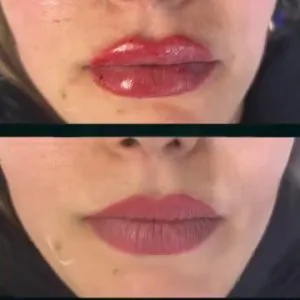 Dr. Yalda Attarzadeh Lip Filler Injection Center (4) مرکز تزریق فیلر لب دکتر یلدا عطار زاده بهترین مرکز تزریق فیلر لب در اصفهان