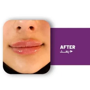 Dr. Yalda Attarzadeh Lip Filler Injection Center مرکز تزریق فیلر لب دکتر یلدا عطار زاده بهترین مرکز تزریق فیلر لب در اصفهان