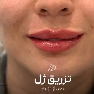 Farzaneh danesh ip gel injection center (1) مرکز تزریق ژل لب فرزانه دانش بهترین مرکز تزریق ژل لب در اصفهان