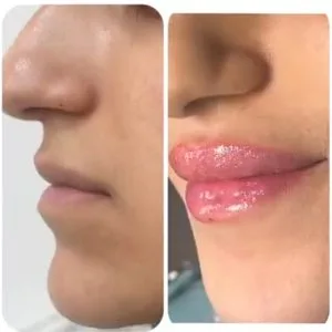 Farzaneh danesh ip gel injection center (2) مرکز تزریق ژل لب فرزانه دانش بهترین مرکز تزریق ژل لب در اصفهان