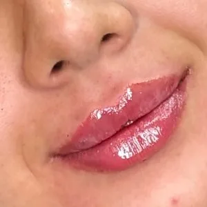 Farzaneh danesh ip gel injection center (3) مرکز تزریق ژل لب فرزانه دانش بهترین مرکز تزریق ژل لب در اصفهان