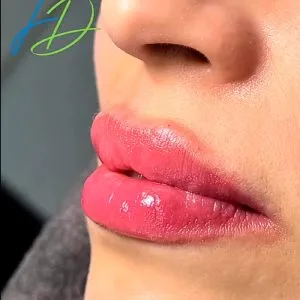 Farzaneh danesh ip gel injection center (4) مرکز تزریق ژل لب فرزانه دانش بهترین مرکز تزریق ژل لب در اصفهان