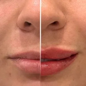 Farzaneh danesh ip gel injection center مرکز تزریق ژل لب فرزانه دانش بهترین مرکز تزریق ژل لب در اصفهان