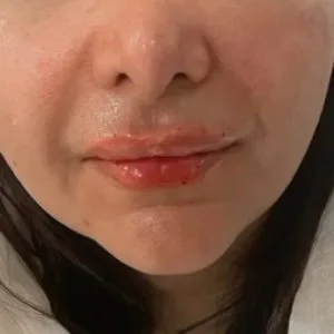 Karma Lip gel injection center (1) مرکز تزریق ژل لب کارما بهترین مرکز تزریق ژل لب در اصفهان