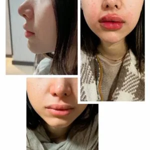 Karma Lip gel injection center (3) مرکز تزریق ژل لب کارما بهترین مرکز تزریق ژل لب در اصفهان