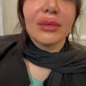 Karma Lip gel injection center (4) مرکز تزریق ژل لب کارما بهترین مرکز تزریق ژل لب در اصفهان
