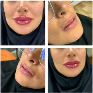 Lip gel injection center emad khorvash (1) مرکز تزریق ژل لب عماد خوروش بهترین مرکز تزریق ژل لب در اصفهان