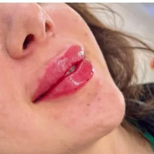 Lip gel injection center emad khorvash مرکز تزریق ژل لب عماد خوروش بهترین مرکز تزریق ژل لب در اصفهان