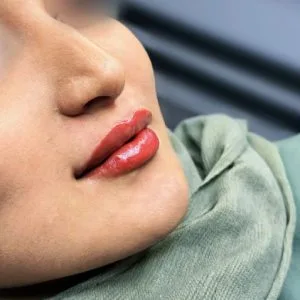 Lip gel injection center emad khorvash (2) مرکز تزریق ژل لب عماد خوروش بهترین مرکز تزریق ژل لب در اصفهان
