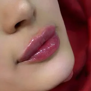 Lip gel injection center emad khorvash (4) مرکز تزریق ژل لب عماد خوروش بهترین مرکز تزریق ژل لب در اصفهان