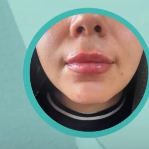 Sadaf lip Filler Injection Center (1) مرکز تزریق فیلر لب صدف بهترین مرکز تزریق فیلر لب در اصفهان