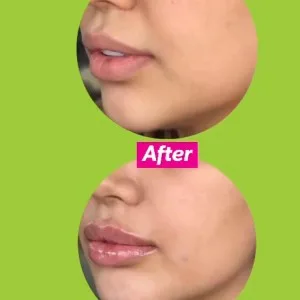 Sadaf lip Filler Injection Center (2) مرکز تزریق فیلر لب صدف بهترین مرکز تزریق فیلر لب در اصفهان