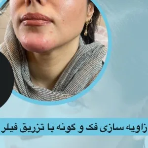 Sadaf lip Filler Injection Center (3) مرکز تزریق فیلر لب صدف بهترین مرکز تزریق فیلر لب در اصفهان