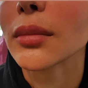 Sadaf lip Filler Injection Center (4) مرکز تزریق فیلر لب صدف بهترین مرکز تزریق فیلر لب در اصفهان