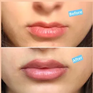 Sadaf lip Filler Injection Center مرکز تزریق فیلر لب صدف بهترین مرکز تزریق فیلر لب در اصفهان
