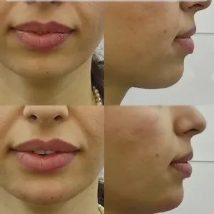 Sinayar lip gel injection center (1) مرکز تزریق ژل لب سینایار بهترین مرکز تزریق ژل لب در اصفهان