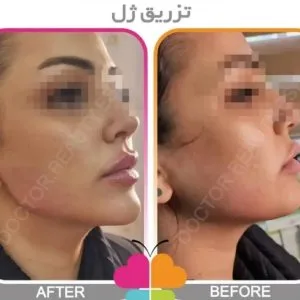 Sinayar lip gel injection center مرکز تزریق ژل لب سینایار بهترین مرکز تزریق ژل لب در اصفهان