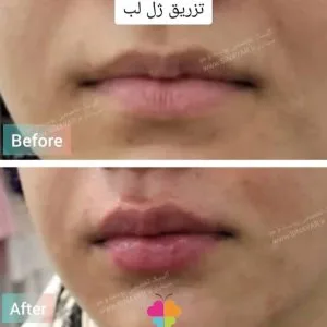 Sinayar lip gel injection center (2) مرکز تزریق ژل لب سینایار بهترین مرکز تزریق ژل لب در اصفهان