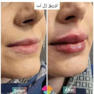 Sinayar lip gel injection center (3) مرکز تزریق ژل لب سینایار بهترین مرکز تزریق ژل لب در اصفهان