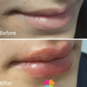 Sinayar lip gel injection center (4) مرکز تزریق ژل لب سینایار بهترین مرکز تزریق ژل لب در اصفهان