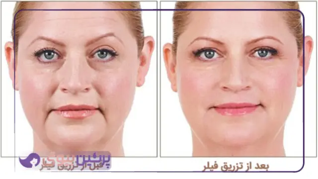 بهترین مرکز فیلر در اصفهان