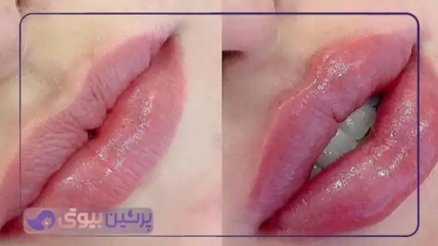 نکاتی خواندنی برای پیدا کردن بهترین مرکز تزریق ژل لب