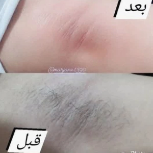 اپیلاسیون مرجانه