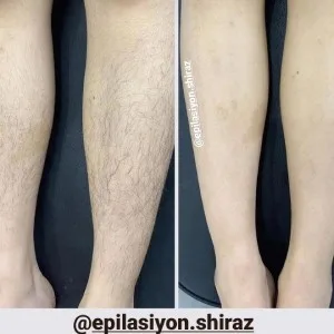 Shiraz waxing salon سالن اپیلاسیون شیراز، بهترین سالن اپیلاسیون بدن در شیراز